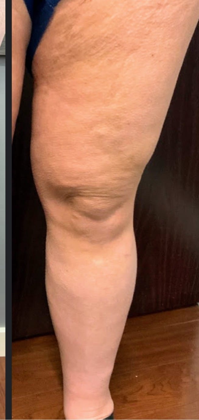 After ambulatory phlebectomy
