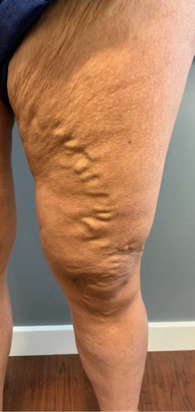 Before ambulatory phlebectomy