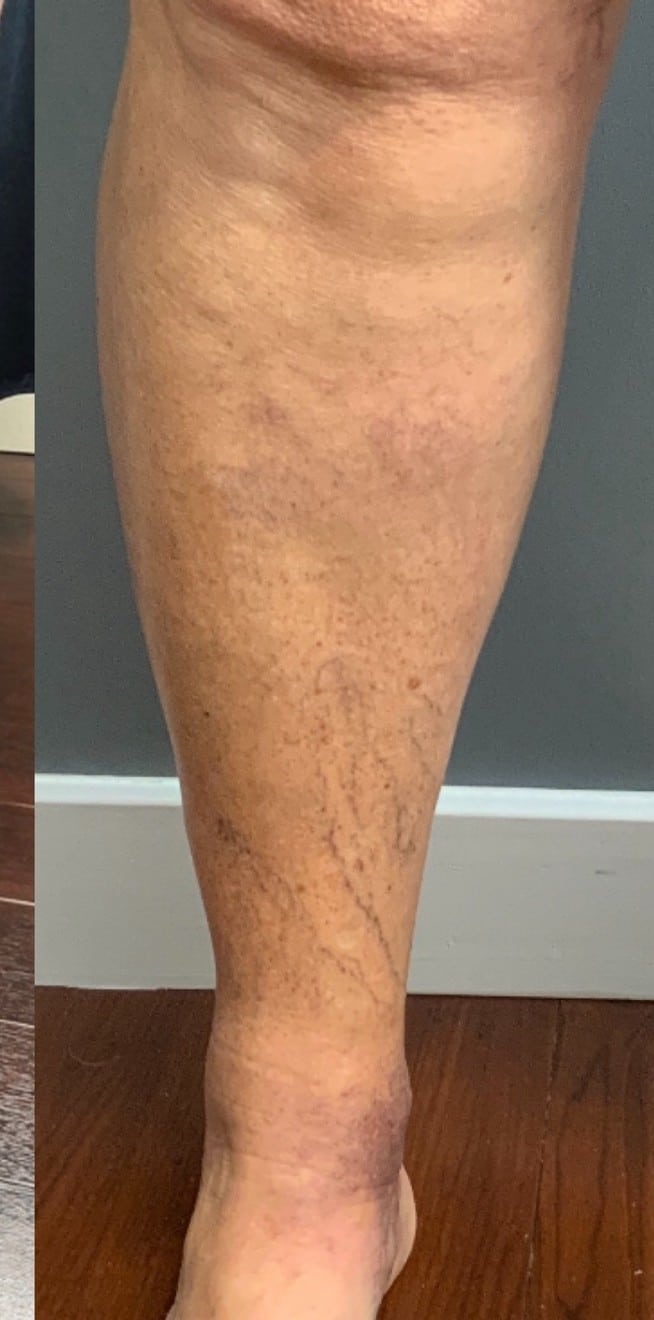 After sclerotherapy treatment