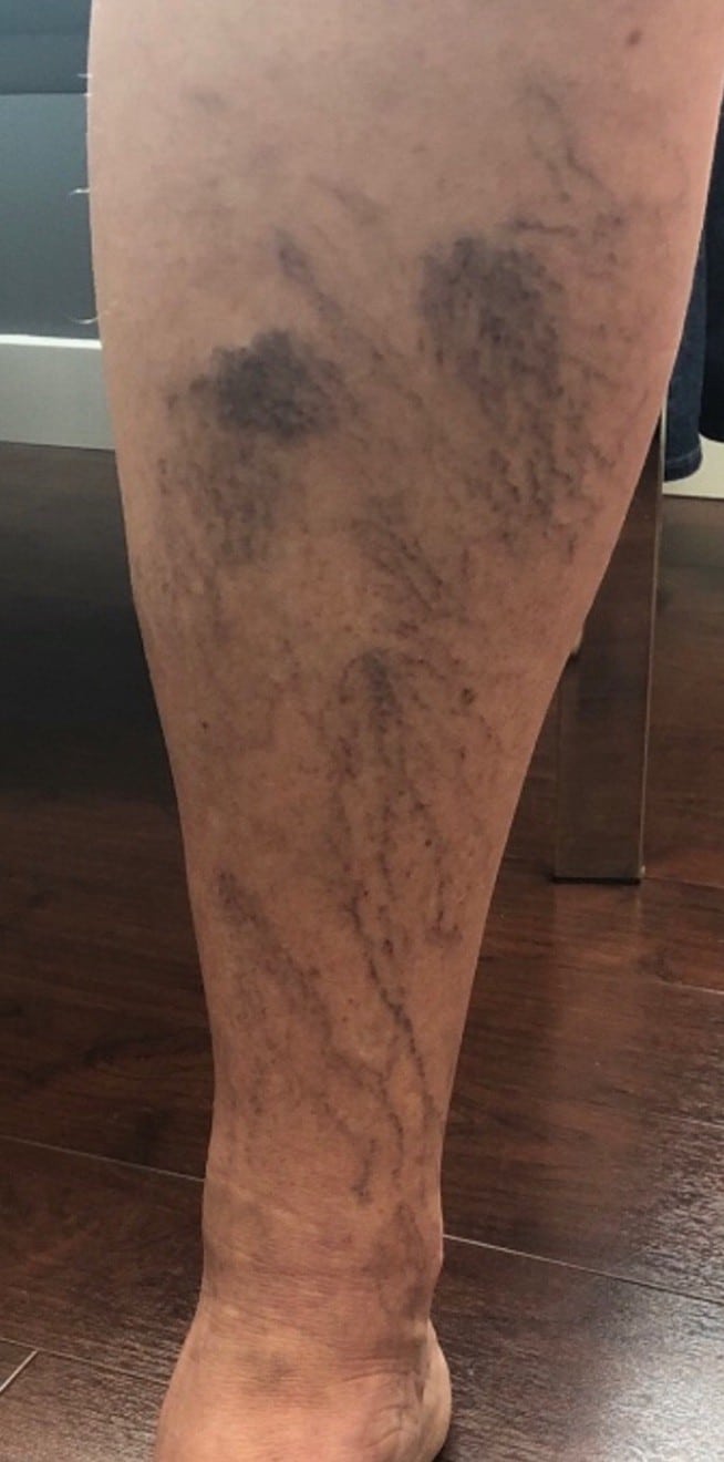Before sclerotherapy treatment